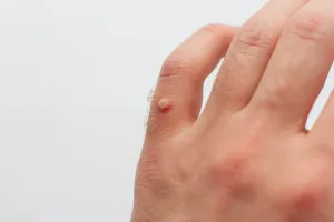 Wart Removal
